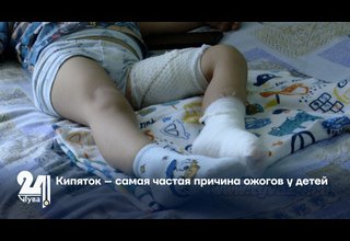 Кипяток – самая частая причина ожогов у детей