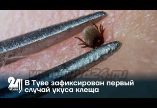 В Туве зафиксирован первый случай укуса клеща
